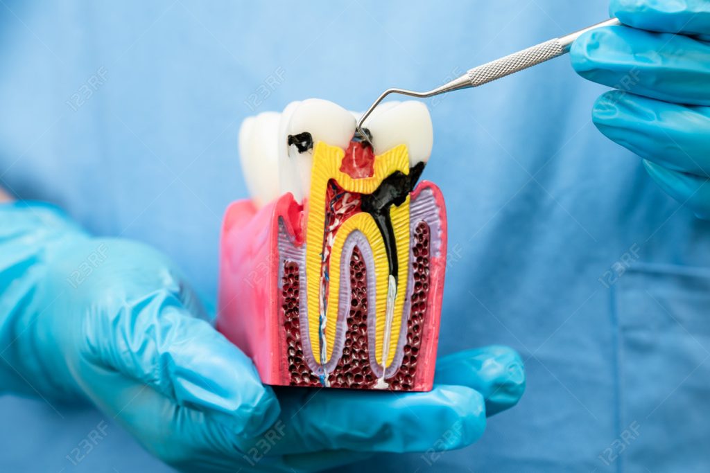 Root Canals