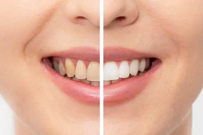 teeth-whitening-image